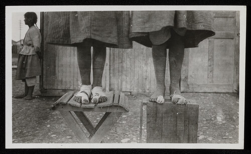 Children's bandaged, frost-injured feet, Caucasus, 1920s
